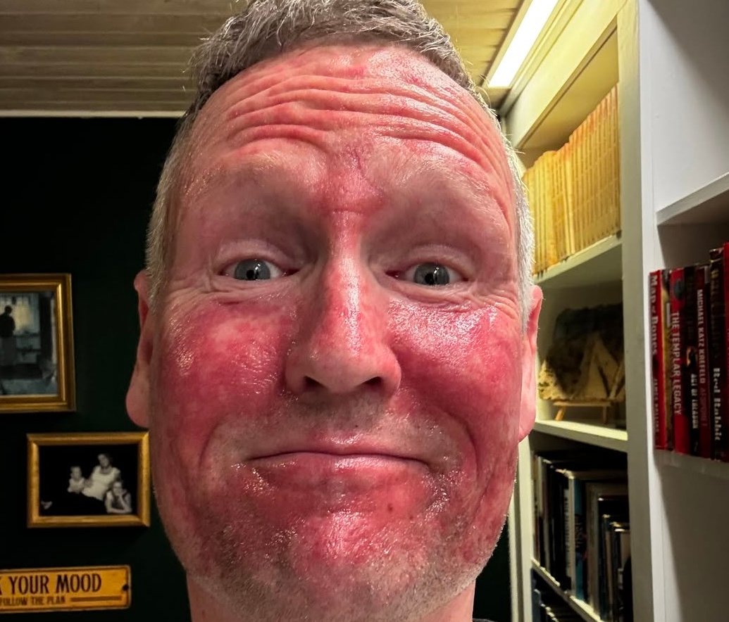 Danmark, Solkrem | Dansk politiker advarer: – Ansiktet mitt ser smadret ut