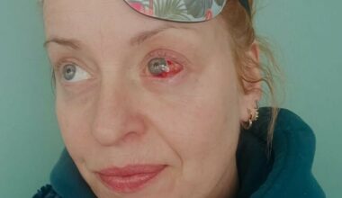 Feirer bursdag med øyelapp og antibiotika