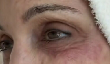 Bethenny Frankel avslører sjokkerende infeksjon etter luksusferie på St. Barths