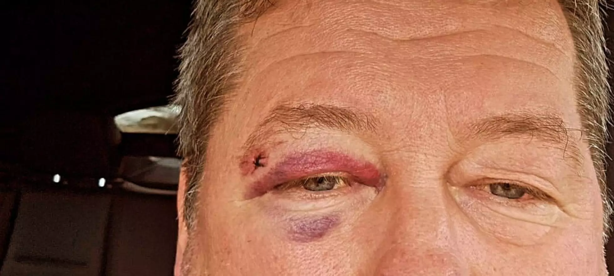 - Blødde noe voldsomt