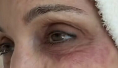 Bethenny Frankel avslører sjokkerende infeksjon etter luksusferie på St. Barths