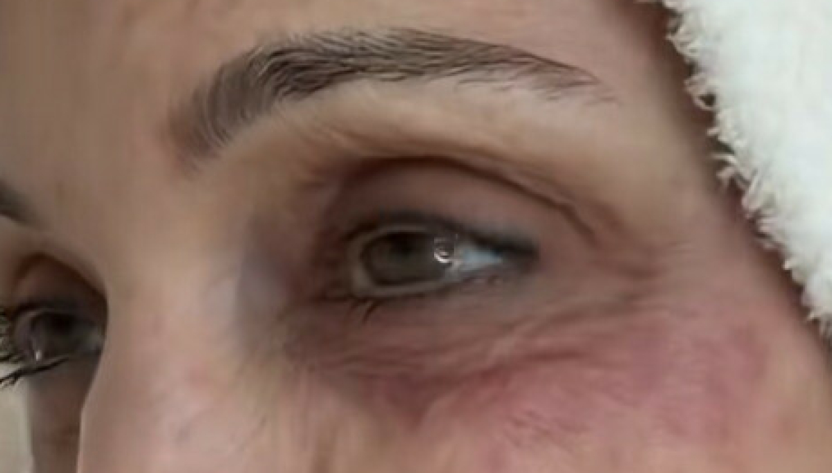 Bethenny Frankel avslører sjokkerende infeksjon etter luksusferie på St. Barths