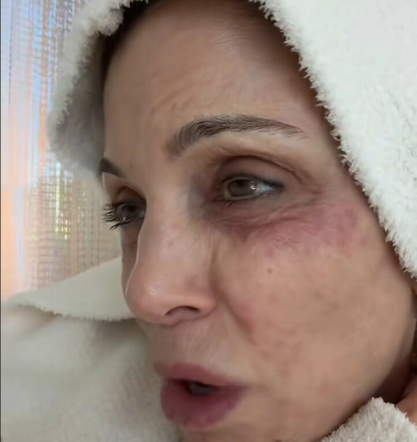 VONDT: Bethenny Frankel holder vanligvis følgerne sine godt oppdatert på det som skjer i livet hennes. Utslettet var intet unntak. Foto: TikTok / @bethennyfrankel