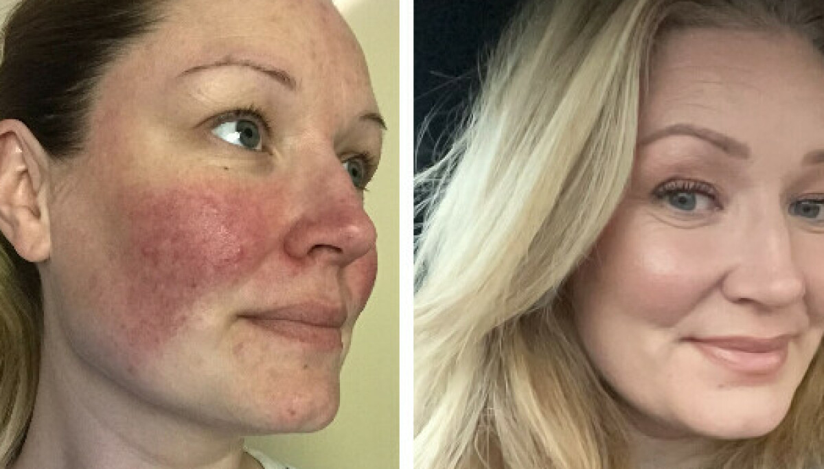 Margrethe deler sin erfaring med rosacea.