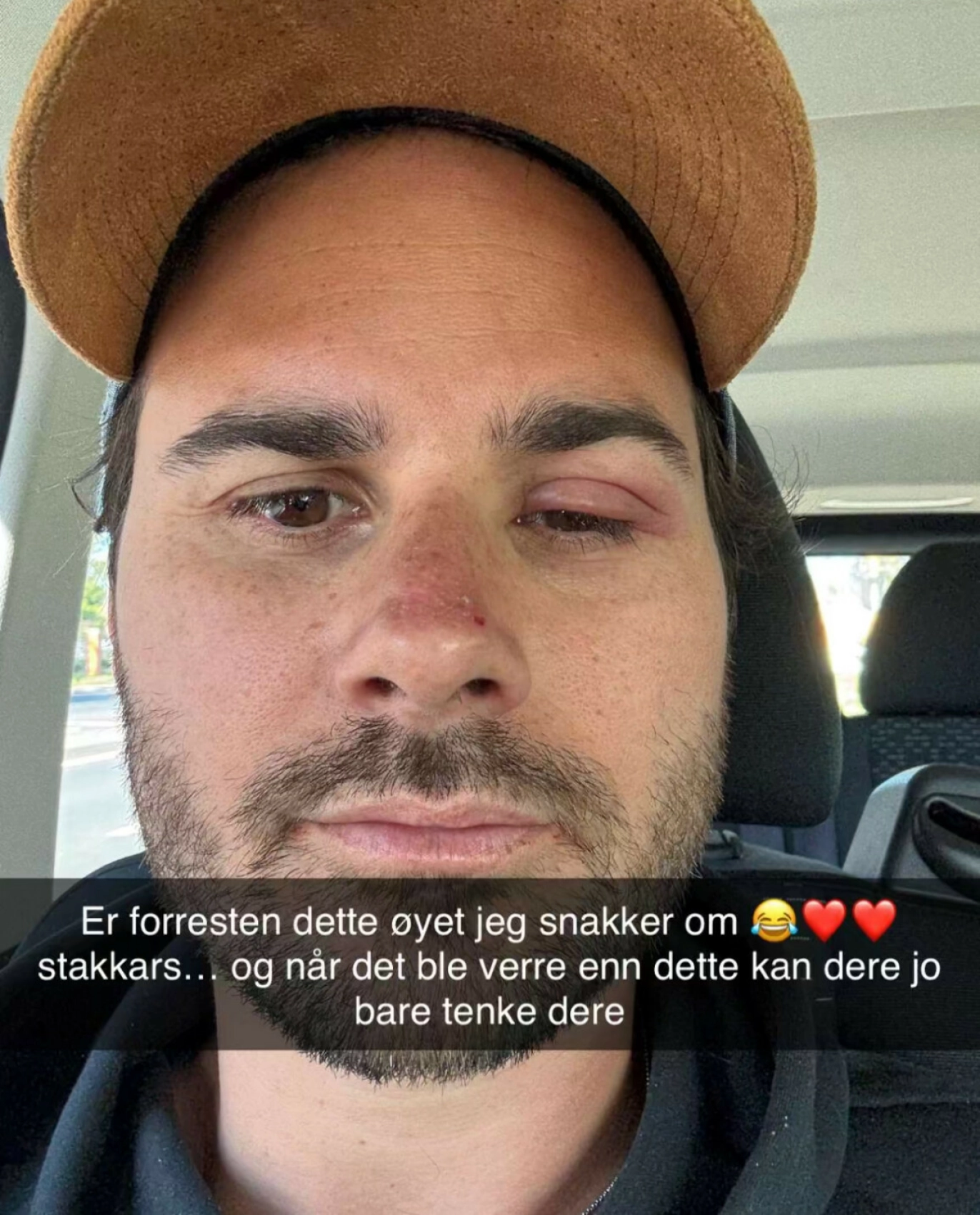 INFEKSJON: Michael måtte oppsøke lege da øyet ble verre og mer betent. Foto: Skjermdump fra Snapchat