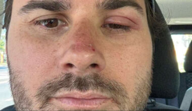 Michael Nereng Hansson måtte oppsøke lege på bryllupsreise