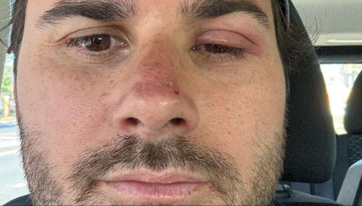 Michael Nereng Hansson måtte oppsøke lege på bryllupsreise