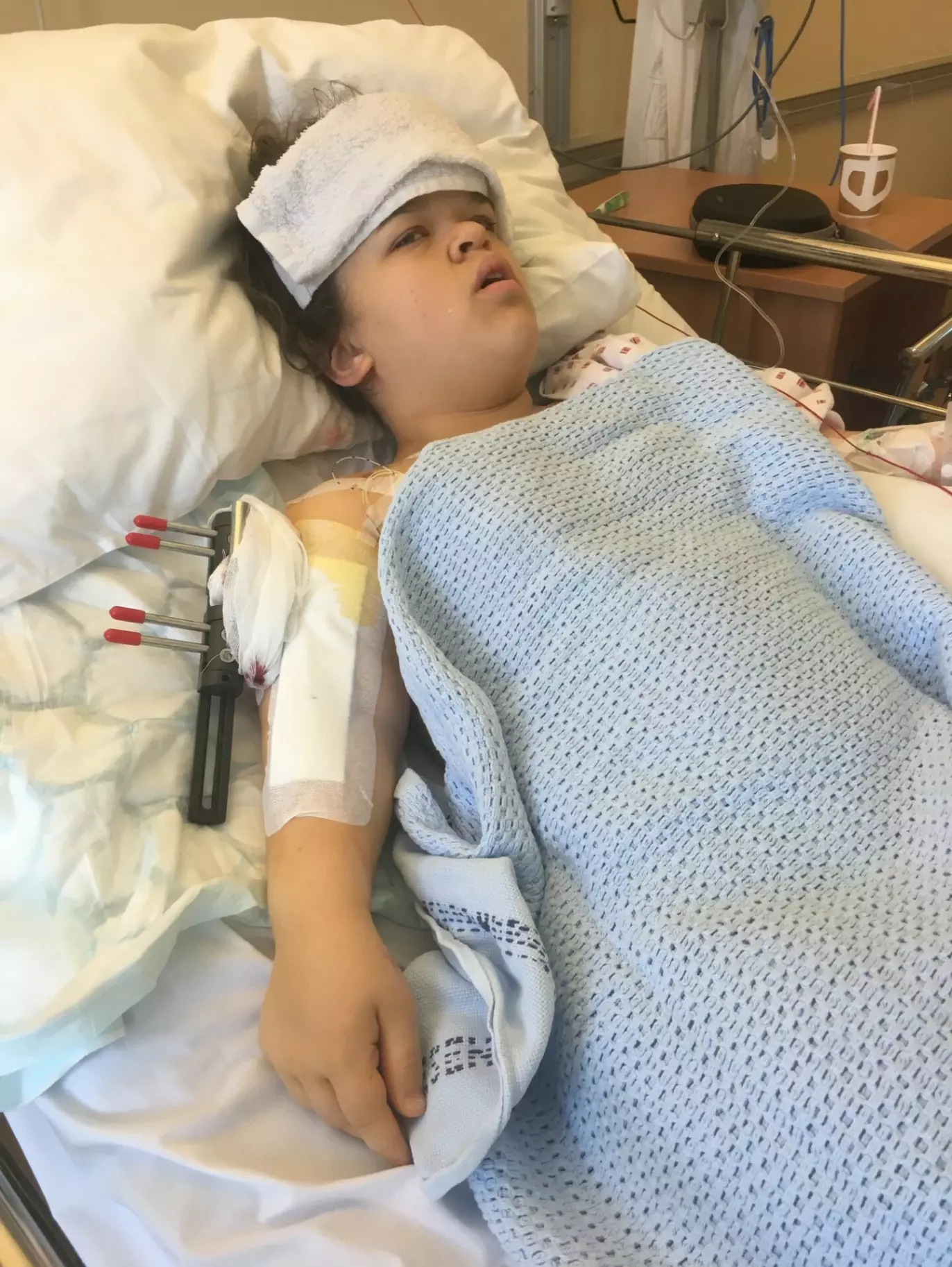OMFATTENDE: Maria har forlenget både armer, legger og lår. Her fra forlengingen av armene. Foto: Privat