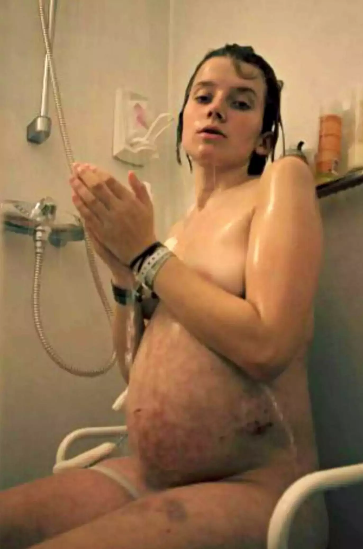 ÅPEN: Amanda viser fram hvordan magen hennes så ut. Kreftformen ligger som et belegg i buken og produserer proteinholdig væske. Foto: Privat