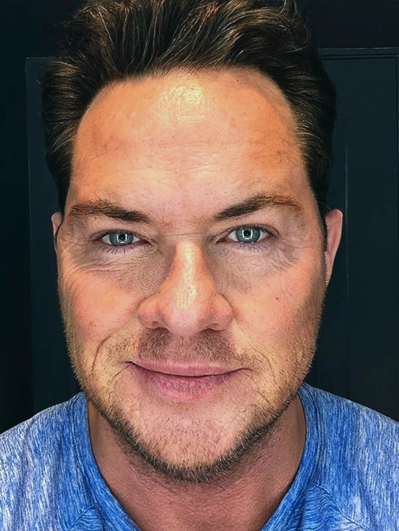 ETTER-BILDE: Paulie viste også frem resultatet etter operasjonen. Foto: @paul_g_connell / Instagram