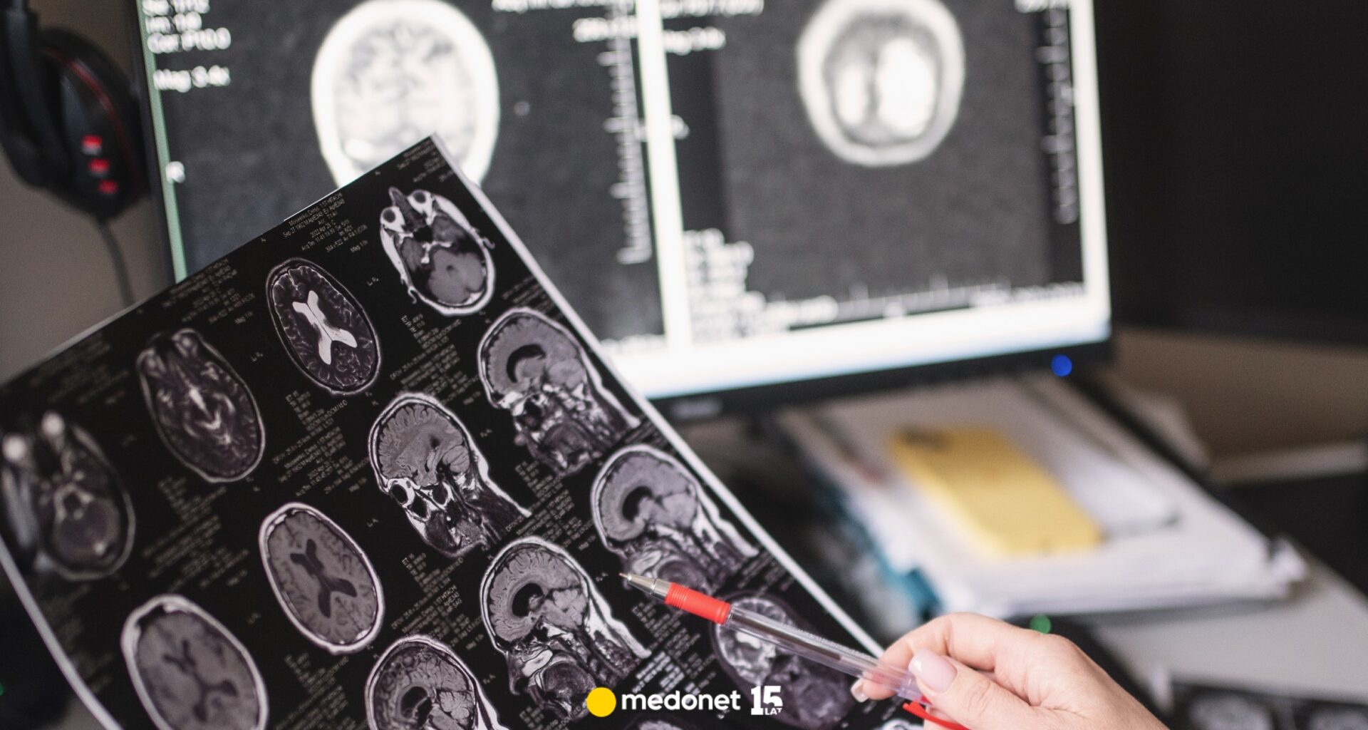 Po diagnozie pacjenci żyją średnio 10 lat. Choroba rozwija się w ukryciu