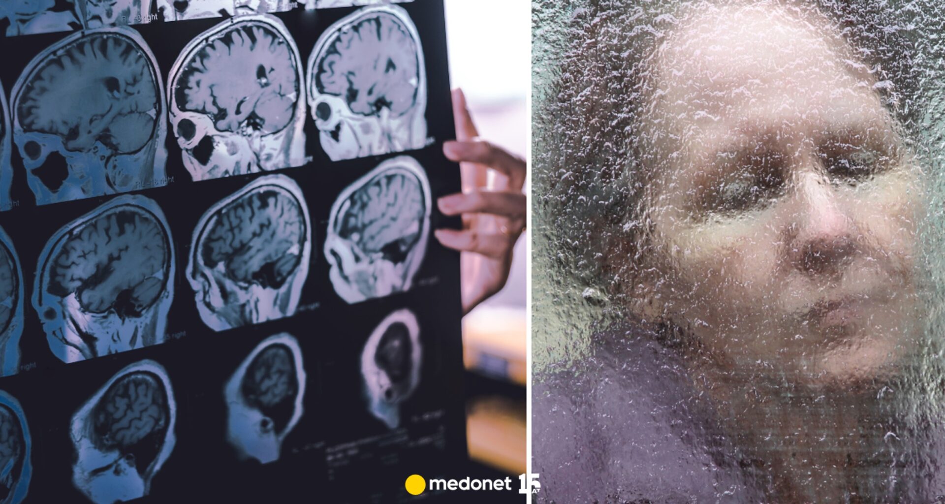 Choroba Alzheimera: jak zatrzymać wzrost liczby chorych w Polsce