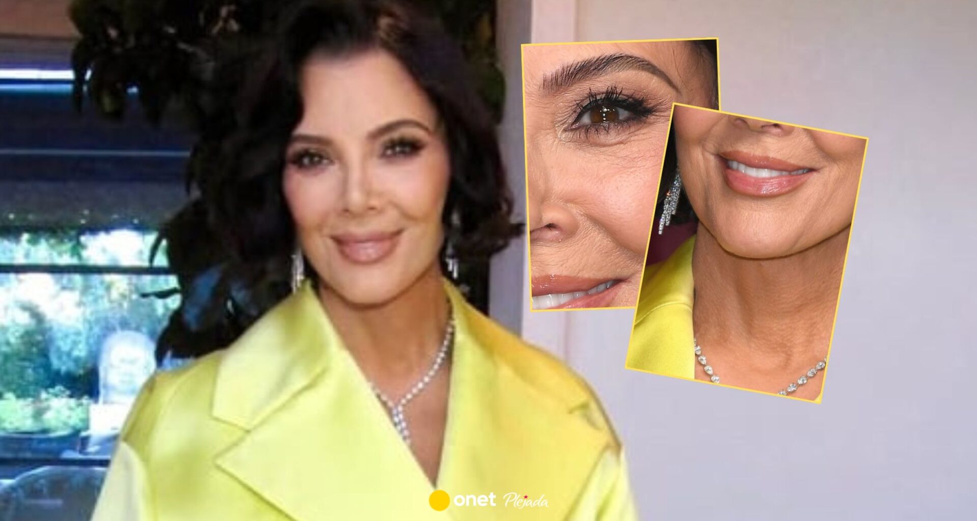 Tak naprawdę wygląda Kris Jenner po operacji. Internauci nie kryli zdziwienia