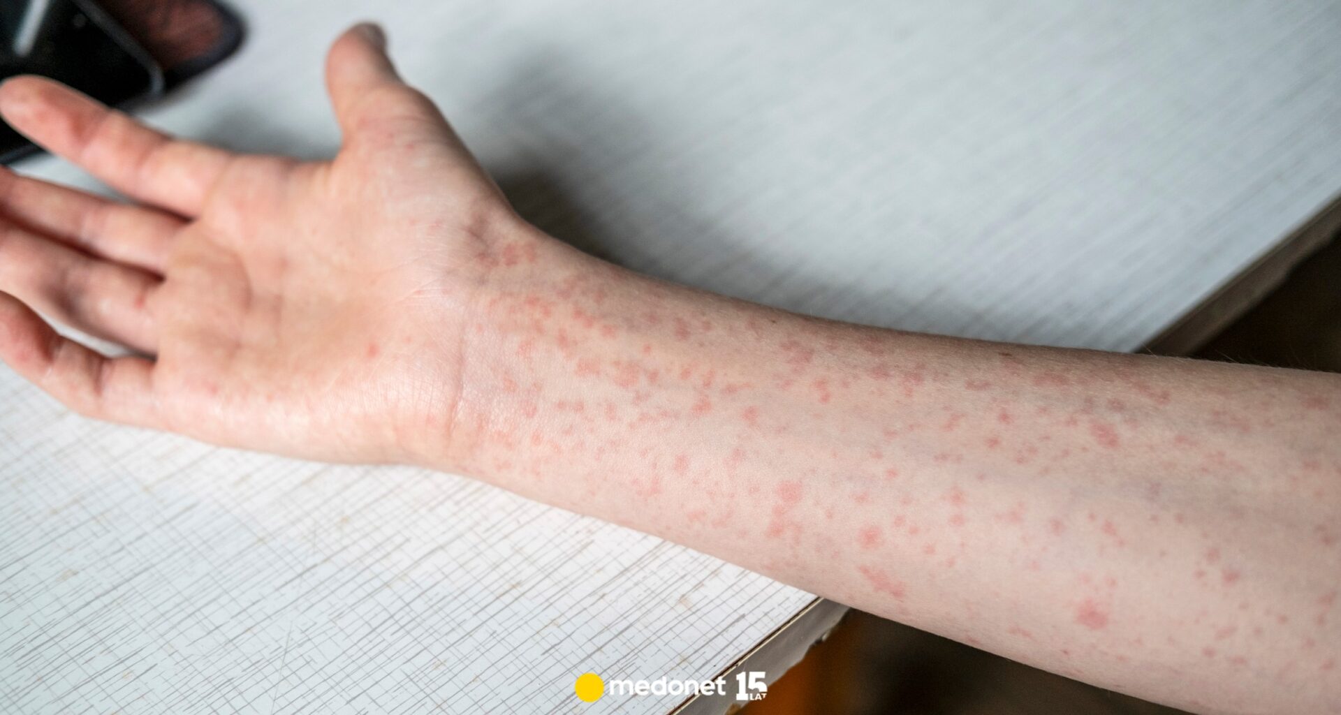 Ognisko odry na Podkarpaciu. Kolejne przypadki potwierdzone