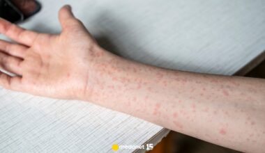 Ognisko odry na Podkarpaciu. Kolejne przypadki potwierdzone