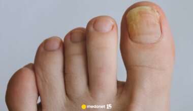 Siarkowodór może leczyć infekcje paznokci. Przełomowe odkrycie naukowców