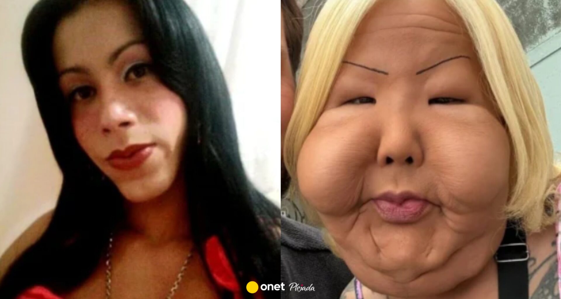 Influencerka chciała poprawić twarz. Teraz walczy, by móc wyglądać normalnie