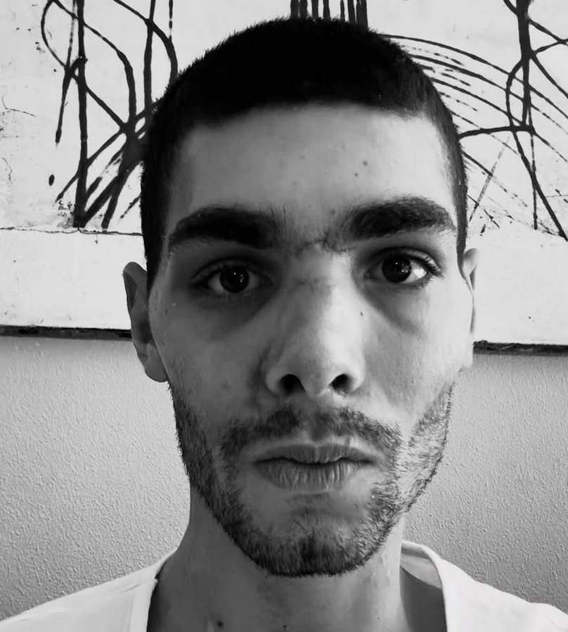 Filippo Baroncini pokazał w mediach społecznościowych jak wyglądała jego twarz po operacjach