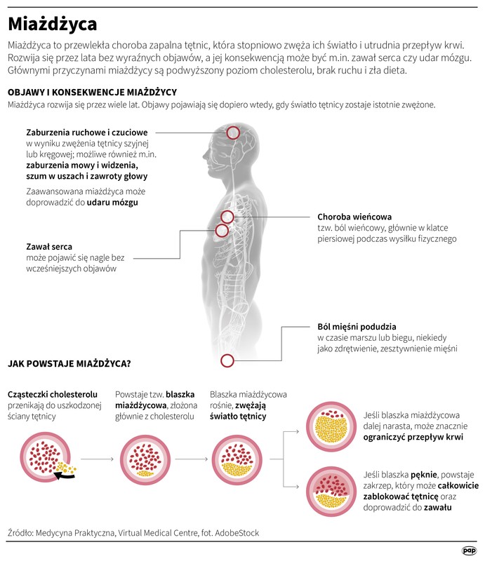 To najczęstsze objawy i skutki miażdżycy