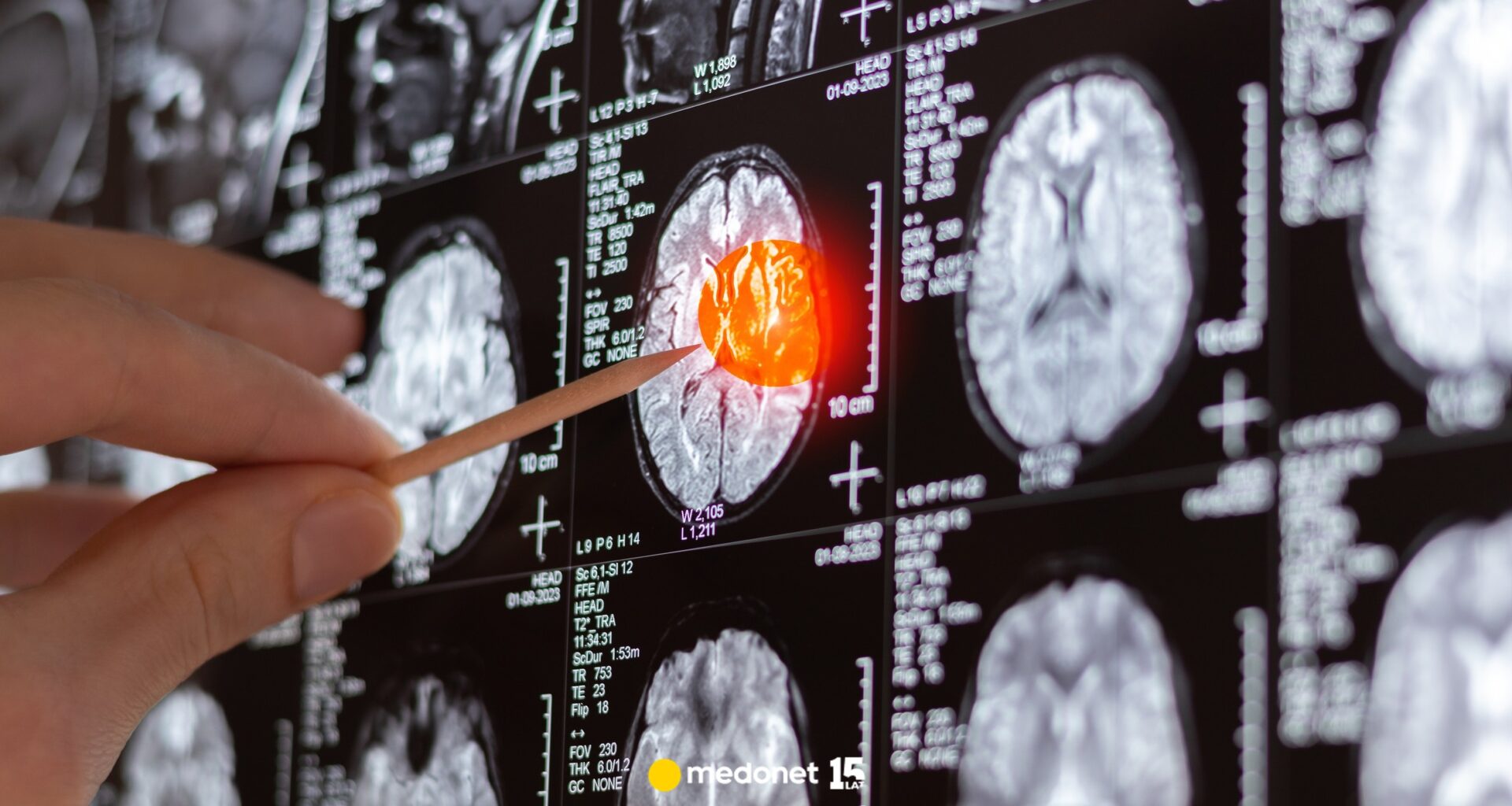 COVID-19 a zmiany w mózgu. Australijscy naukowcy ostrzegają przed skutkami