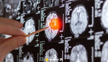 COVID-19 a zmiany w mózgu. Australijscy naukowcy ostrzegają przed skutkami