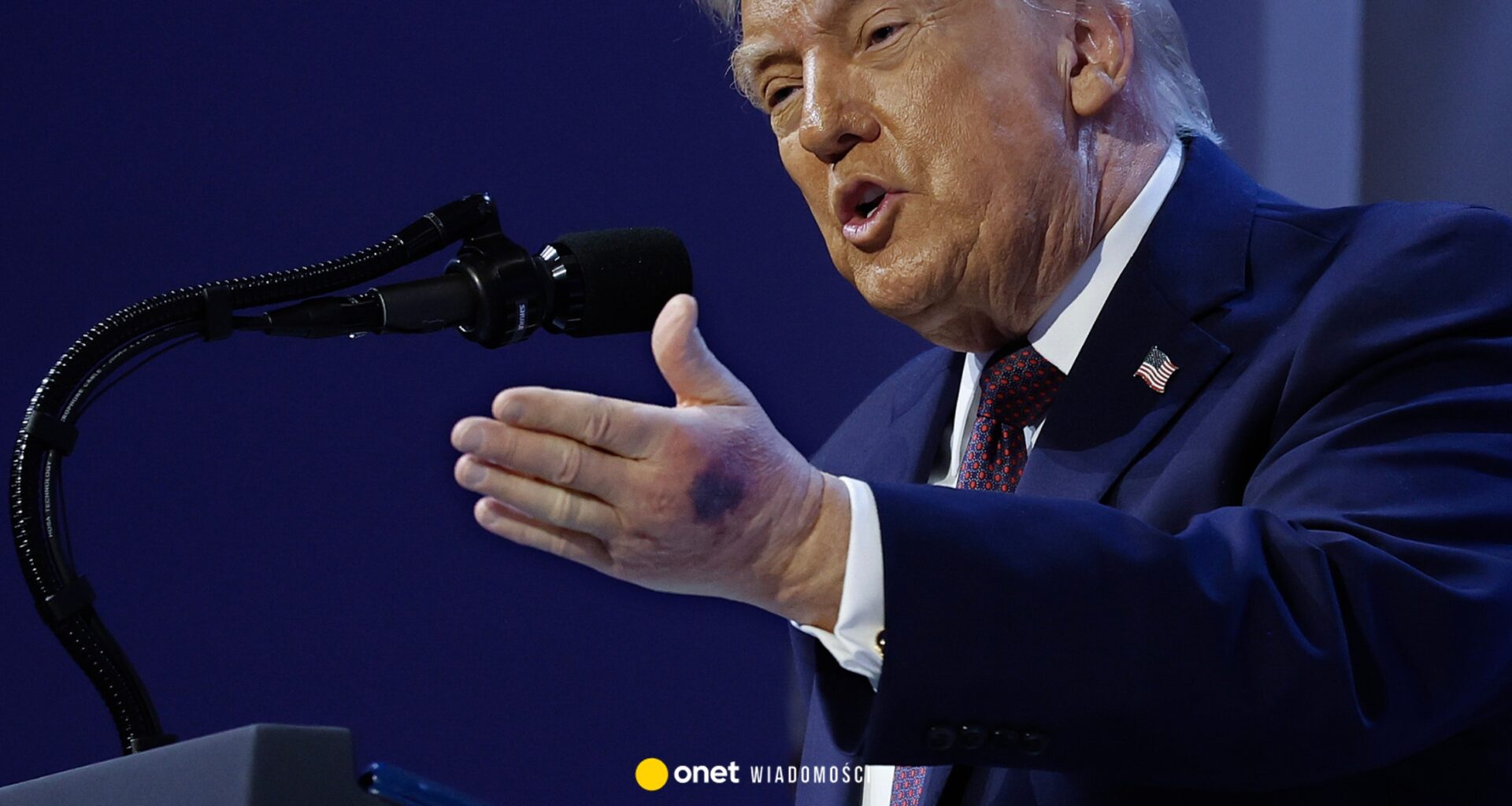 Siniak na dłoniach Donalda Trumpa. Biały Dom dementuje plotki o zdrowiu