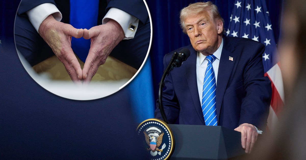 Donald Trump na coś choruje? Tłumaczy się z sinych rąk. Ujawnił prawdę