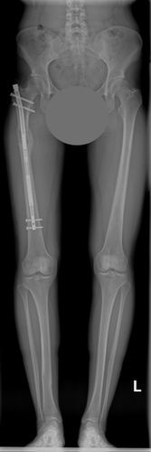 Przez rok Karolina Zelasko będzie żyła ze specjalnym gwoździem w nodze