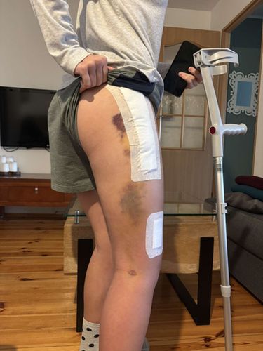 Noga Karoliny Zelasko po operacji