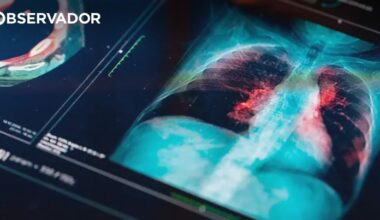 Cancro. Pneumologistas alertam para papel vital do rastreio – Observador