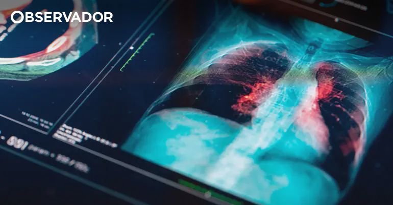 Cancro. Pneumologistas alertam para papel vital do rastreio – Observador