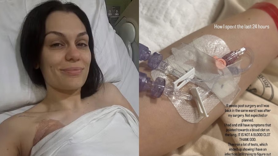 Jessie J foi diagnosticada com infecção pulmonar