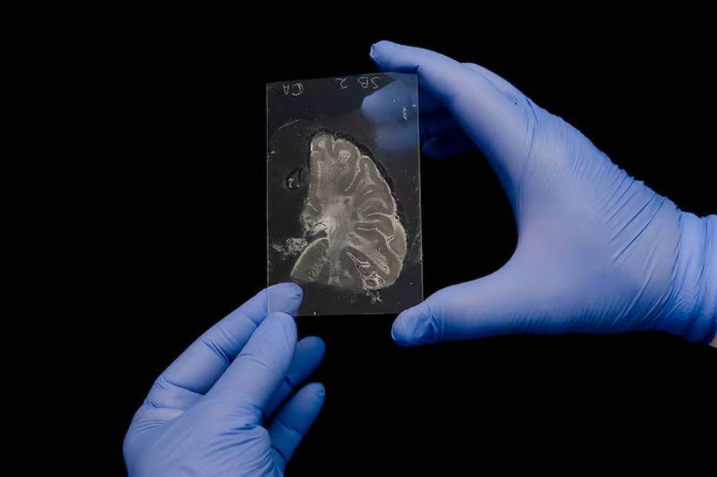 Lítio pode reverter Alzheimer, revela estudo de Harvard - 06/08/2025 - Equilíbrio e Saúde