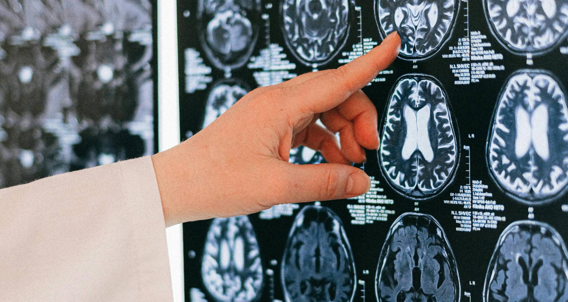 Uso de IA prejudica médicos a detectar sinais de câncer - 12/08/2025 - Equilíbrio e Saúde