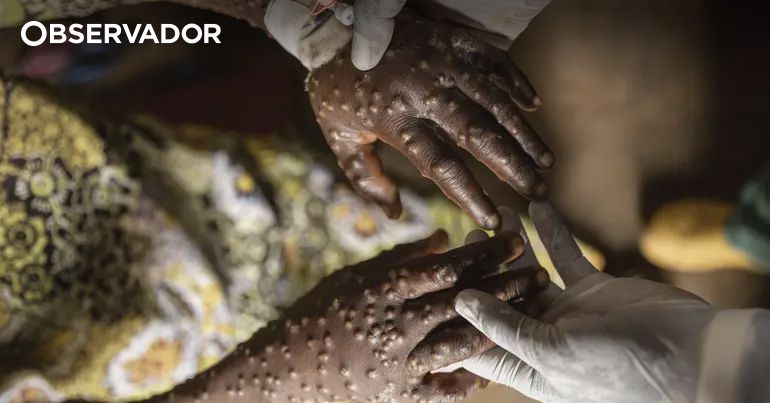 Moçambique quer combater desinformação sobre Mpox – Observador