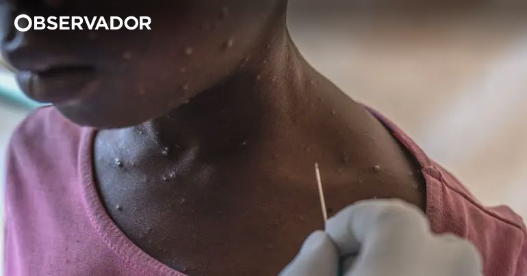 Moçambique confirma mais dois casos de mpox em Maputo – Observador