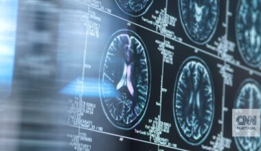 Há um remédio antigo que pode proteger os cérebros da doença de Alzheimer