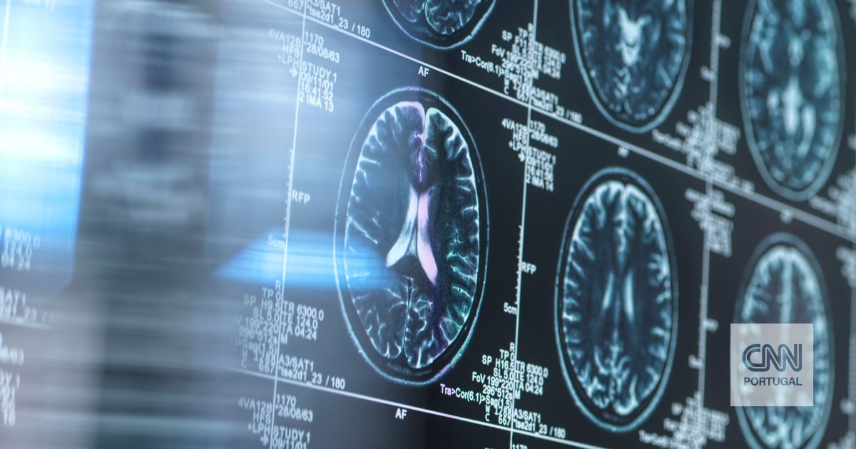 Há um remédio antigo que pode proteger os cérebros da doença de Alzheimer