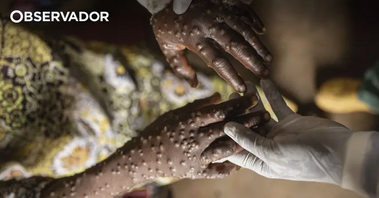 Moçambique regista 66 casos e 810 suspeitos de mpox – Observador