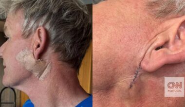 Chef Gordon Ramsay submetido a tratamento para remoção de cancro de pele