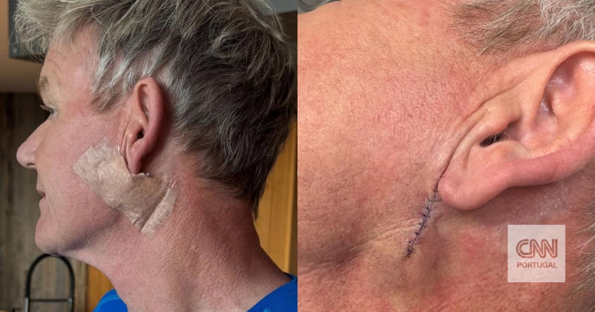 Chef Gordon Ramsay submetido a tratamento para remoção de cancro de pele