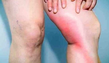 O lipedema, que costuma causar dor e hematomas, é resistente a dietas convencionais -  (crédito:  Reprodução/Pinterest)