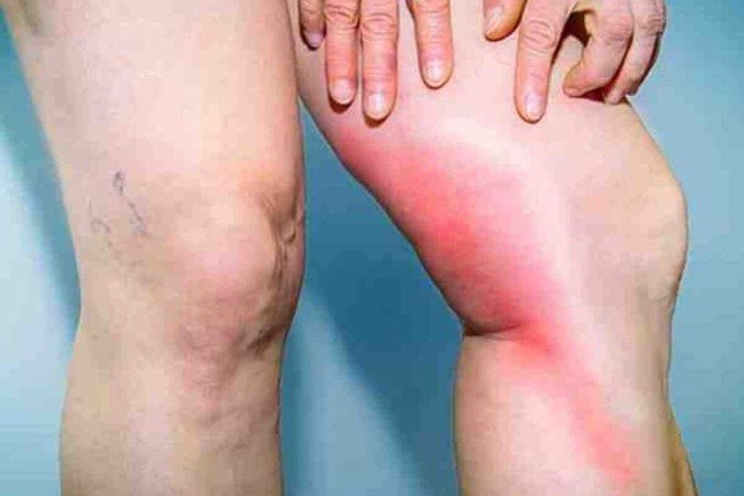 O lipedema, que costuma causar dor e hematomas, é resistente a dietas convencionais -  (crédito:  Reprodução/Pinterest)