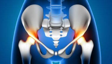Covid-19, corticoide e osteonecrose: entenda a tríade