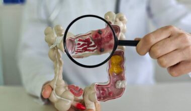 Professor da Uniube comenta projeção de aumento do câncer colorretal no país