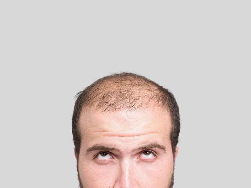 Causas mais comuns da queda de cabelo