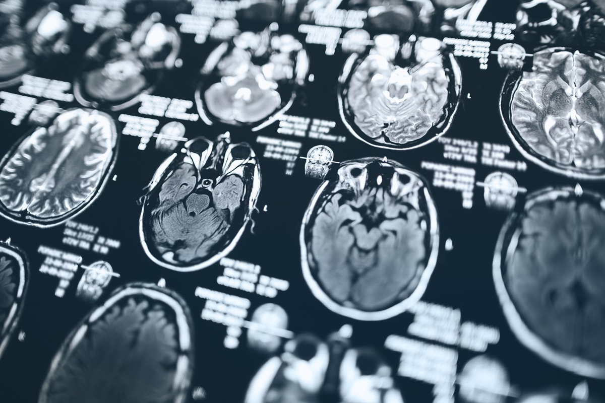 Ressonância magnética da cabeça, imagem por ressonância magnética da cabeça - Dieta mediterrânea pode reduzir risco de Alzheimer, diz estudo