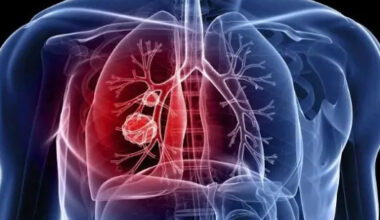 Itapetininga inicia 2ª fase da Campanha “Fique Sabendo Tuberculose 2025” com busca ativa e oferta de exame