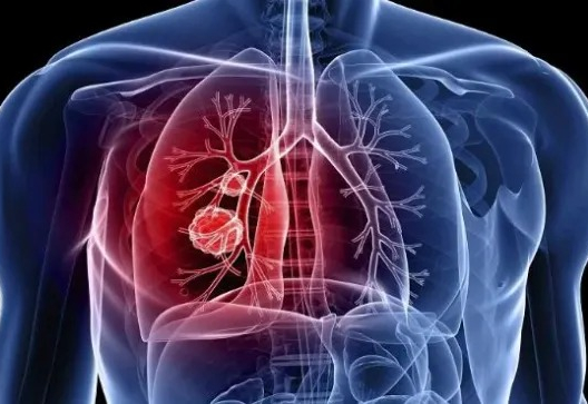 Itapetininga inicia 2ª fase da Campanha “Fique Sabendo Tuberculose 2025” com busca ativa e oferta de exame