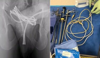 Entenda a prática sexual que deixou homem de 21 anos hospitalizado com cabo USB na uretra